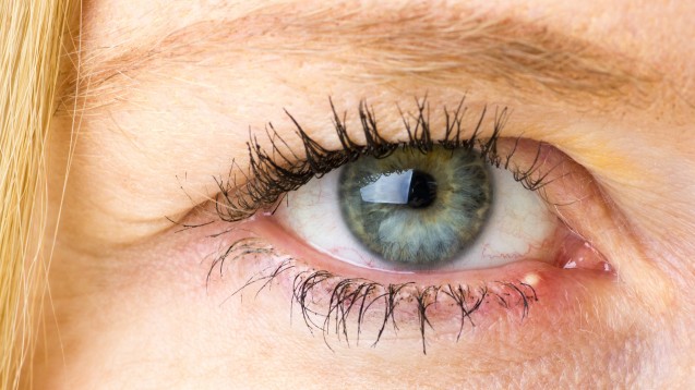 Im auge geht nicht weg hagelkorn Augenmedizin: Antibiotika